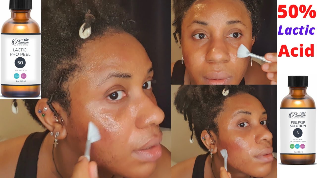 50% LACTIC ACID PEEL on my FACE at HOME/Platinum skin care