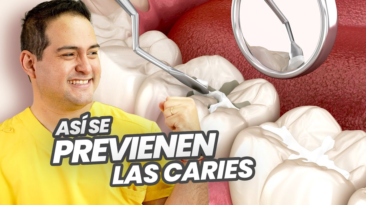 EL SELLADOR o SELLANTE DENTAL DE FOSAS Y FISURAS ¿es BUENO o MALO? ¡HABLAN LOS ESPECIALISTAS!