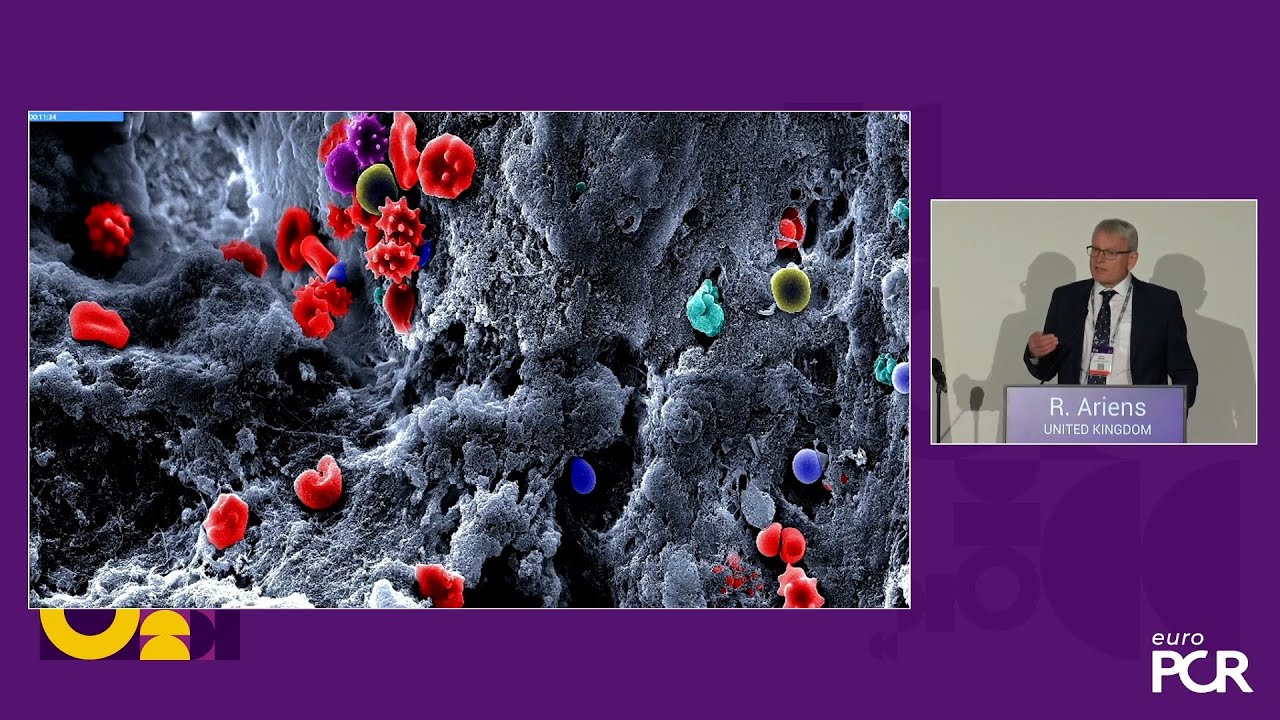 A simple low profile solution to the pulmonary embolism problem: EKOS - EuroPCR 2025