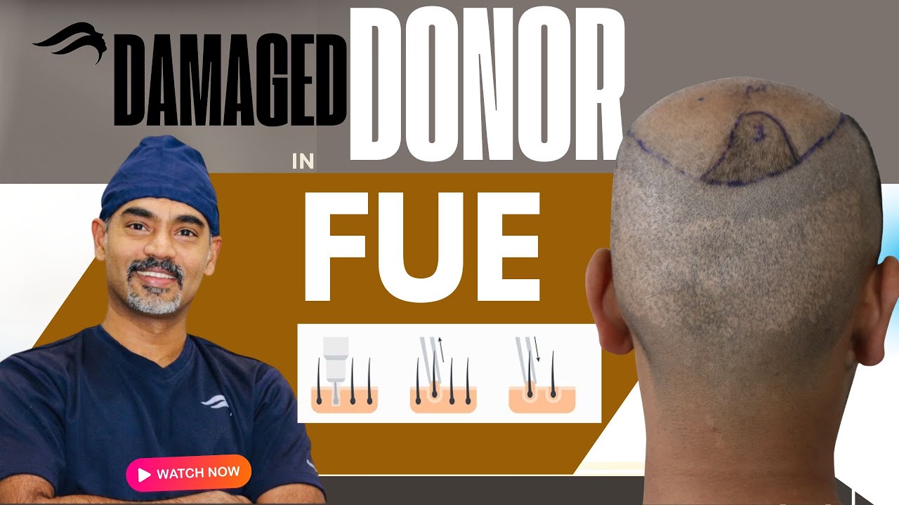 Hair Transplant In Chennai | Best Clinic Surgeon Results & clinic Of Hair Transplant Of Chennai