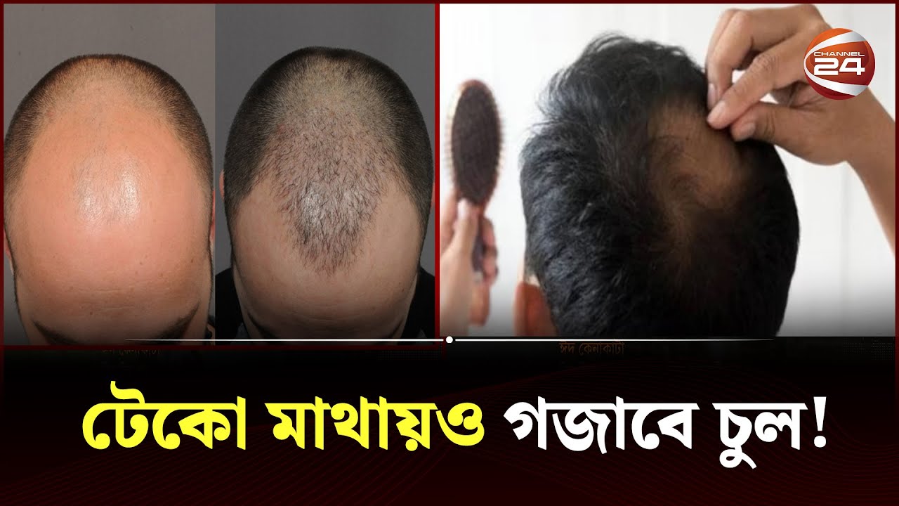 টাক মাথায় চুল গজানোর সহজ উপায় | TAK PROBLEM | Channel 24
