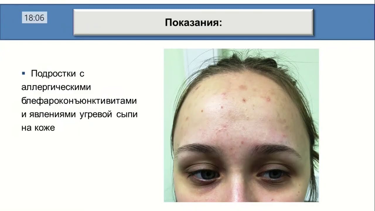 Принципиальный прорыв в терапии блефаритов и синдрома сухого глаза. Собственный опыт в России