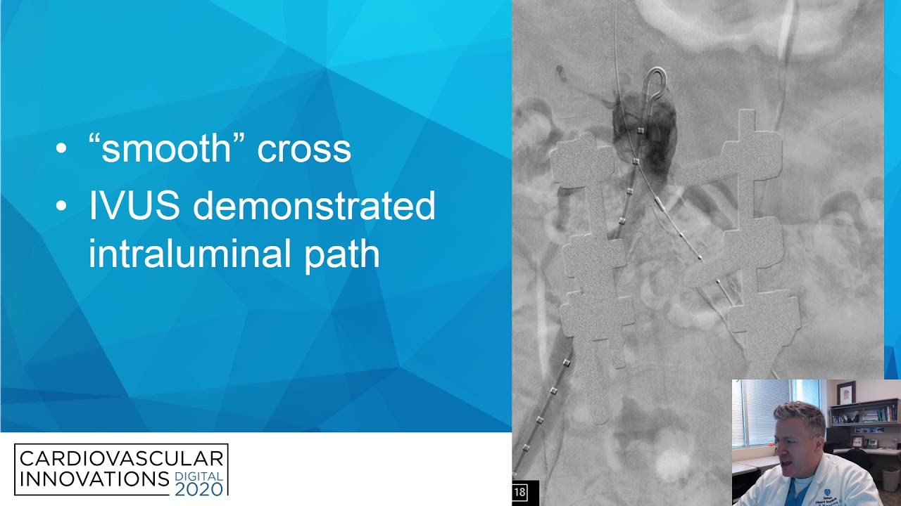 My stent selection Algorithm for Aortoiliacs-Peter Monteleone, MD-Peter Monteleone, MD