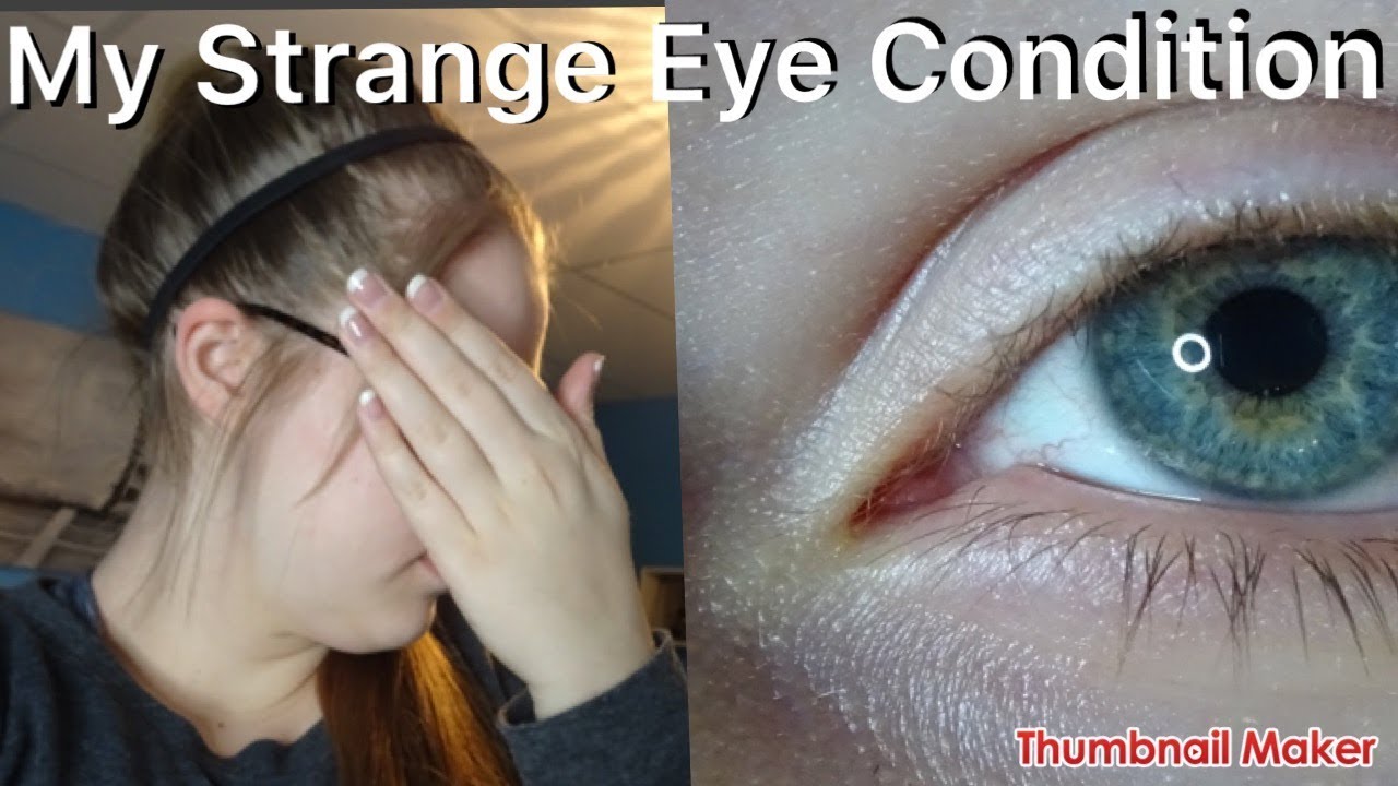 My Strange Eye Condition | Myopia | Astigmatism