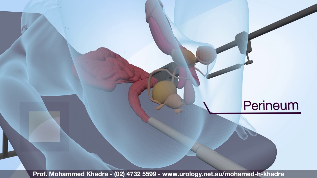 Prostate Biopsy - Professor Mohamed H Khadra