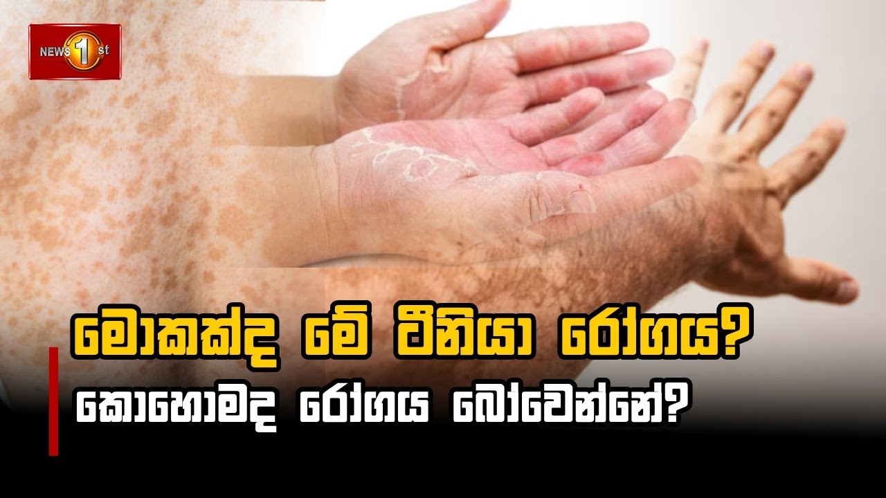 මොකක්ද මේ ටීනියා රෝගය? #Tinea