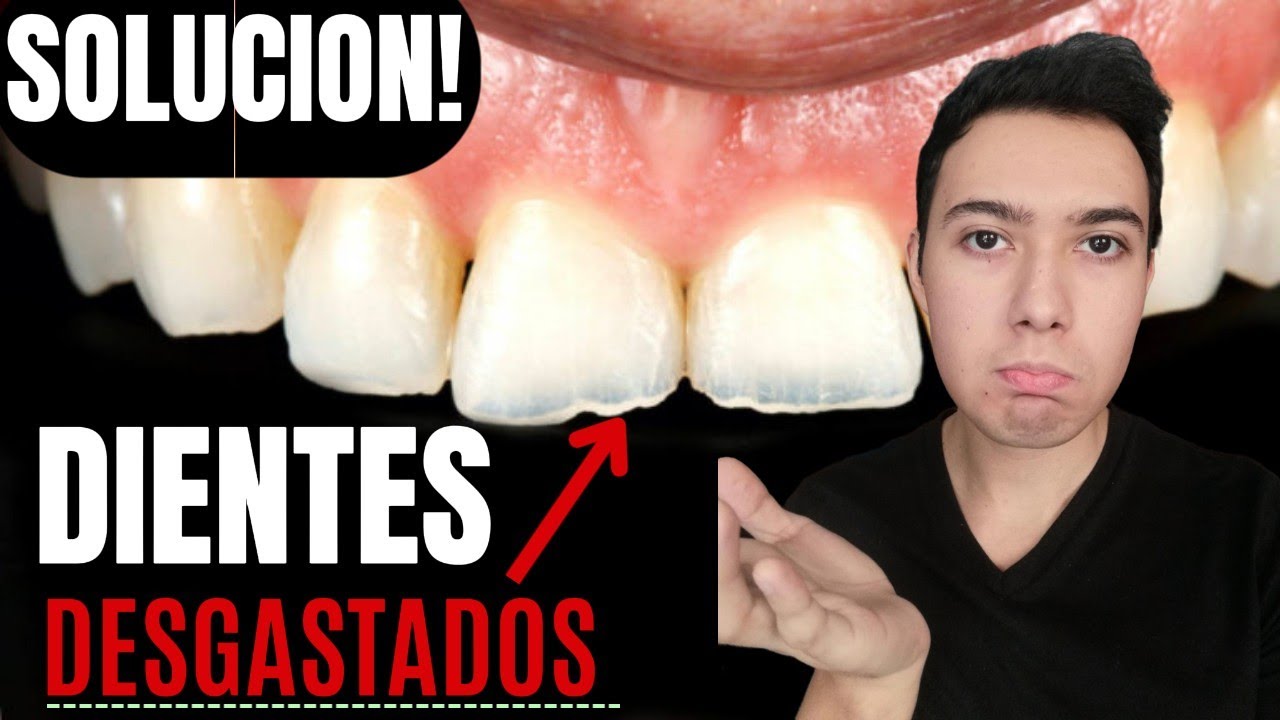 &iquest;Por que los dientes se desgastan? - &iquest;Por qu&eacute; se desgastan tus dientes? Desgaste dental Causas🦷👈