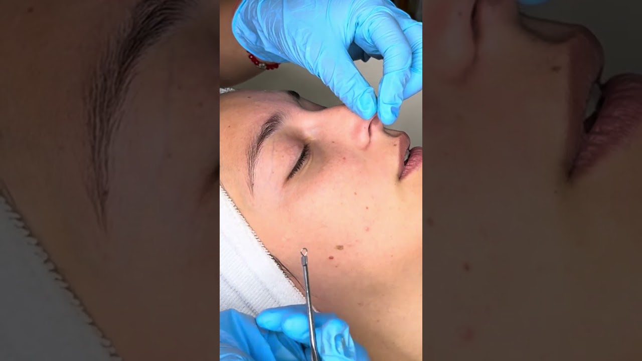 HIGIENE FACIAL CON EXTRACCIONES 