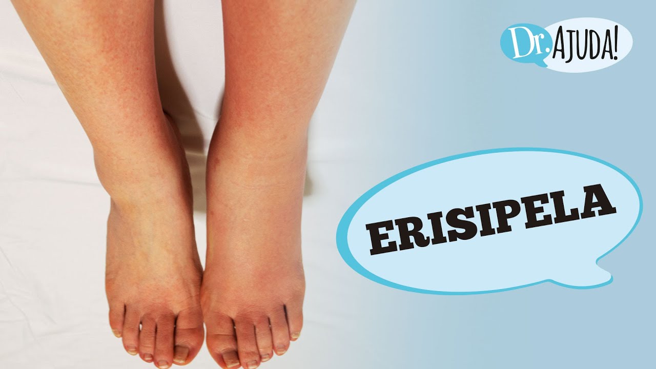 ERISIPELA: O QUE &Eacute;, CAUSAS, SINTOMAS, DIAGN&Oacute;STICO E TRATAMENTO
