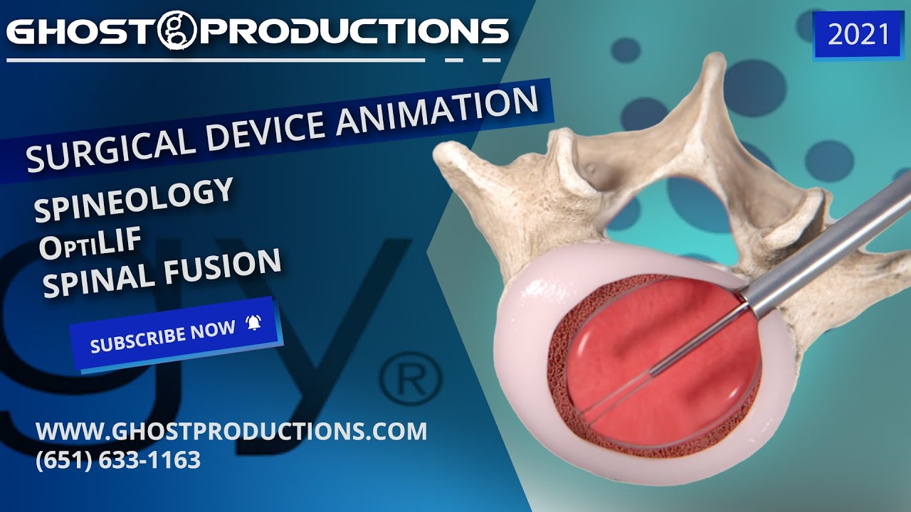 Medical Animation: Spineology OptiLIF Spinal Fusion - Ghost Productions
