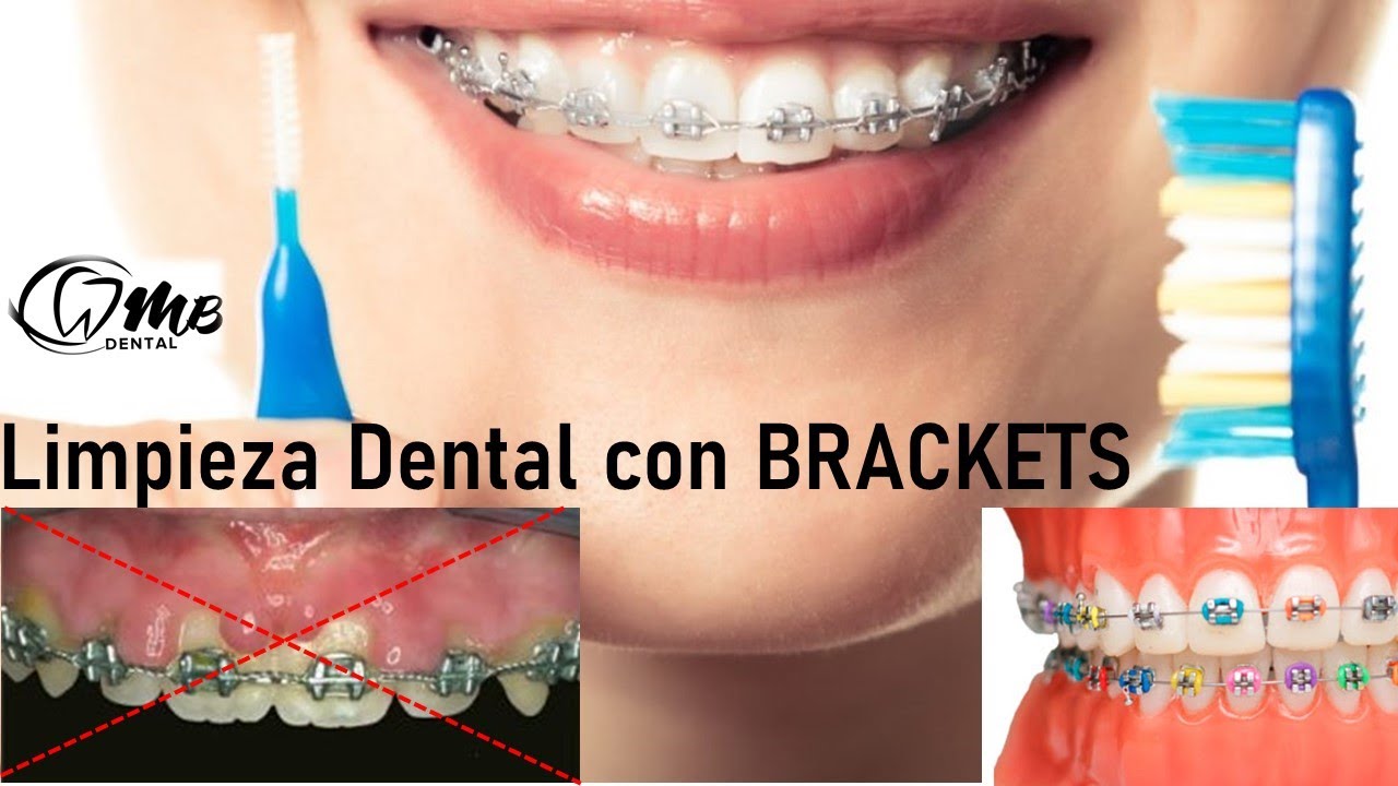 Ya tengo Brackets, y ahora ¿cómo me cepillo los dientes?.