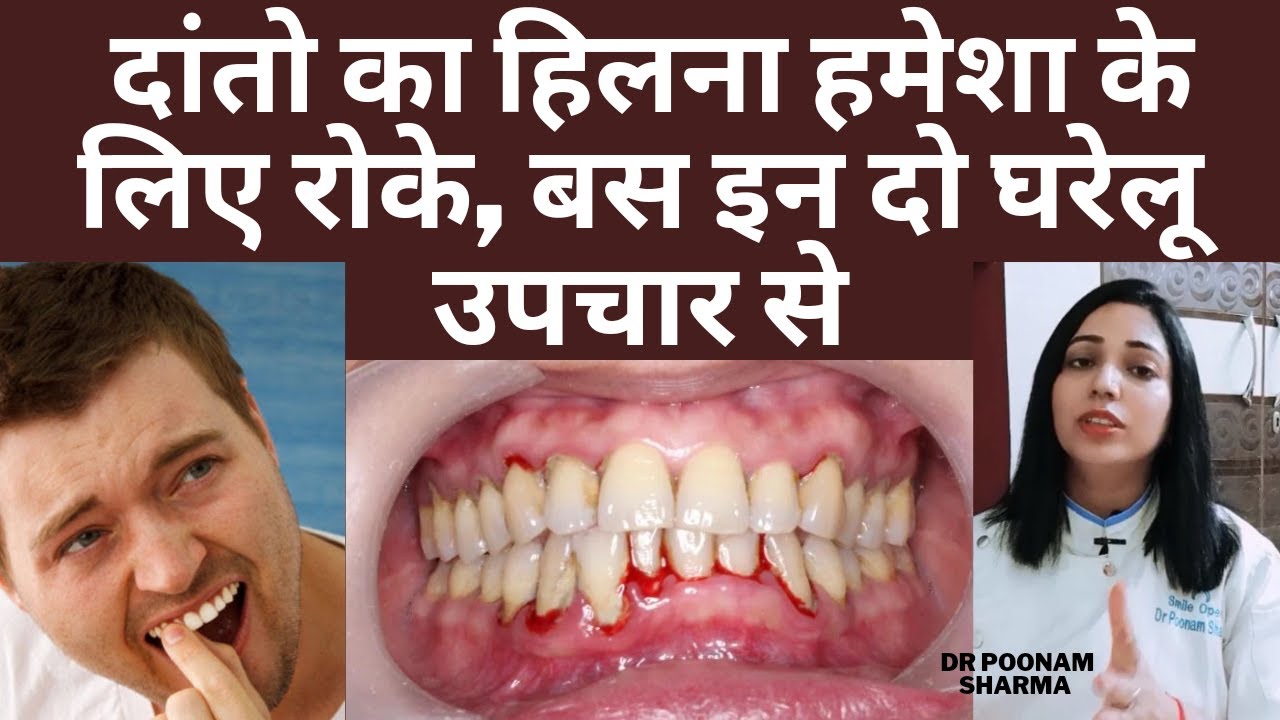 हिलते हुवे दांतों को कैसे रोके और कैसे मजबूत करे | Gharelu Ilaaj Se Danto Ka Hilna Kese Roke