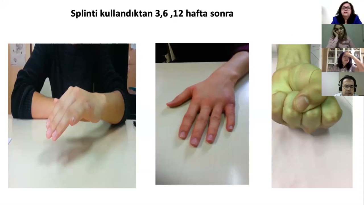 Ekstansör tendon tamiri sonrasında rehabilitasyon-Prof.Dr.Çiğdem Öksüz