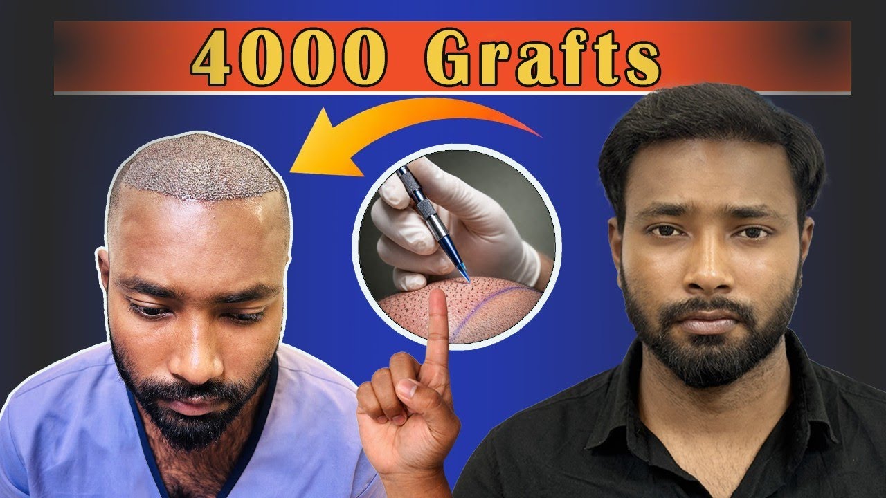 Hair Transplant in Kolkata |Best Results & Treatment in Kolkata #gfc