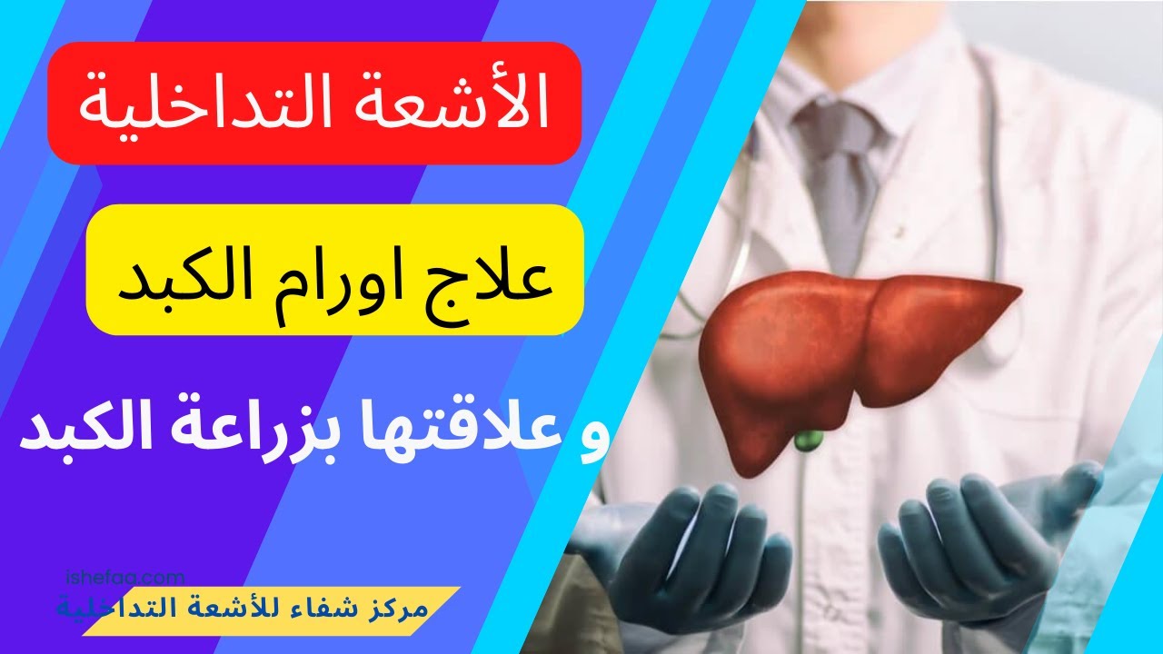 علاج اورام الكبد بالأشعة التداخلية و دورها مع زراعة الكبد