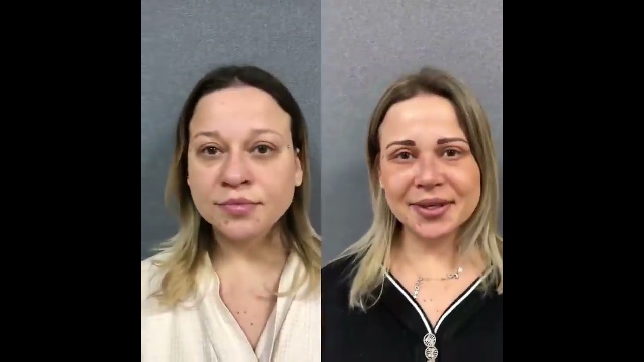 У прекрасной пациентки две недели после комплексной операции - риносептопластики и круговой блефа...