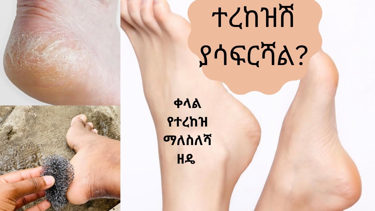 ለደረቀ / ለተሰነጣጠቀ / ተረከዝ ማለስለሻ/