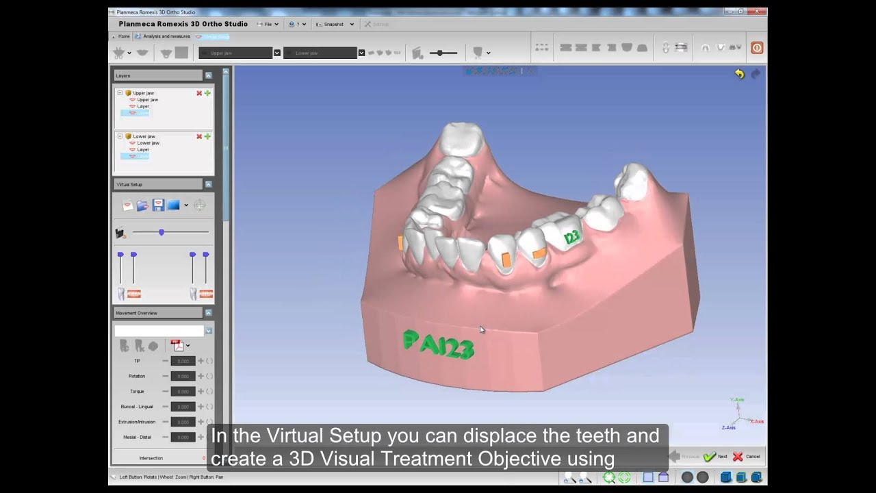 Planmeca Romexis® 3D Ortho Studio – Teeth Segmentation and Virtual Setup