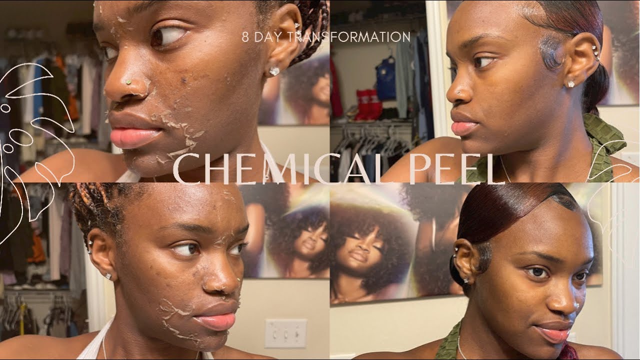 CHEMICAL PEEL | BEFORE AND AFTER | 8 DAY TRANSFORMATION