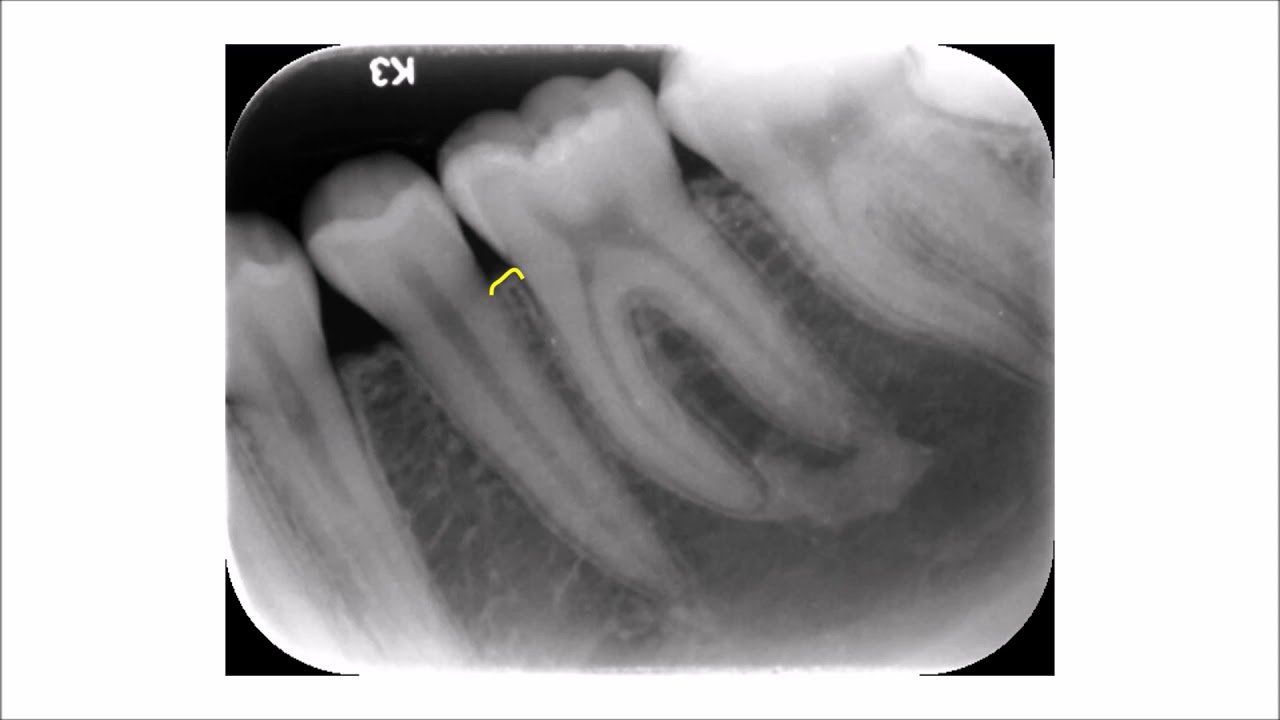 Normal Appearance of the Alveolar Bone Crest Posterior Teeth