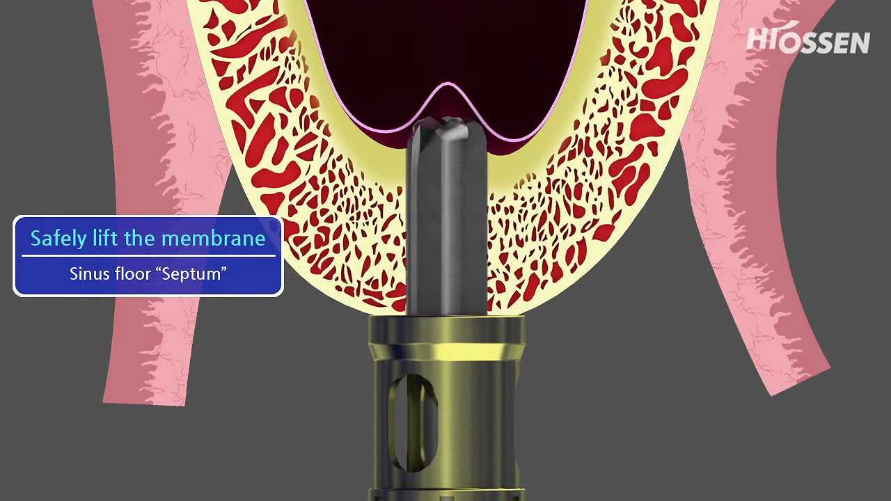 OSSTEM / HIOSSEN CAS-Kit (Crestal Approach Sinus Kit)