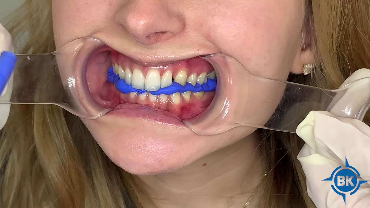 Bausch Arti Bite
