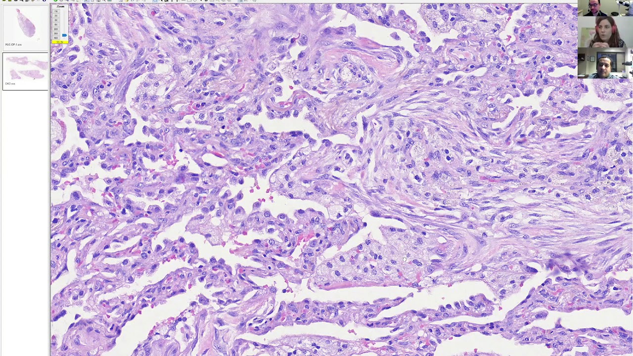 Fresh Air with Sanjay, Matt and Irene: Episode 11: Organizing pneumonia, DAD, and COVID-19 pathology