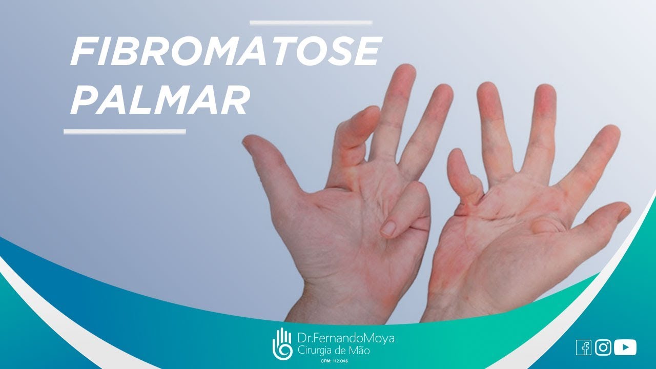 Fibromatose palmar: o que é | Dr. Fernando Moya CRM 112.046