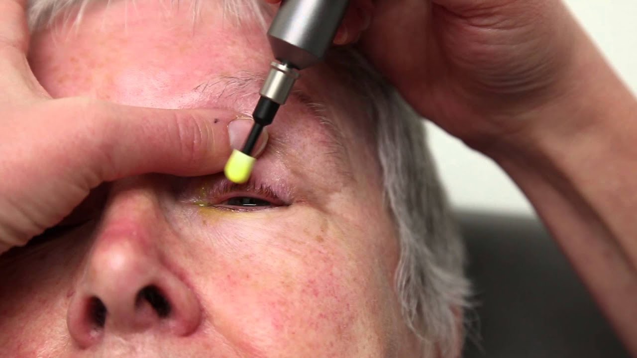 Blepharitis Treatment That Really Works: Blephex Eyelid Cleaning