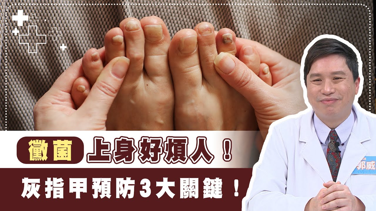 黴菌上身好煩人！灰指甲預防3大關鍵！｜3招護健康