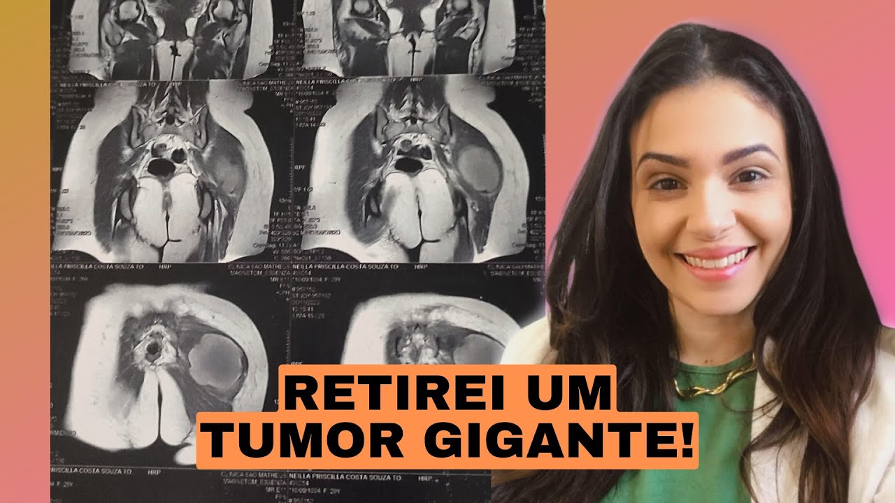 SARCOMA DE PARTES MOLES - EU ESTOU VIVA! - MEU TESTEMUNHO