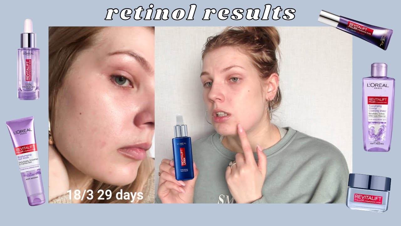Over 30 Days Of Retinol, L'Oréal Revitalift Skincare Review