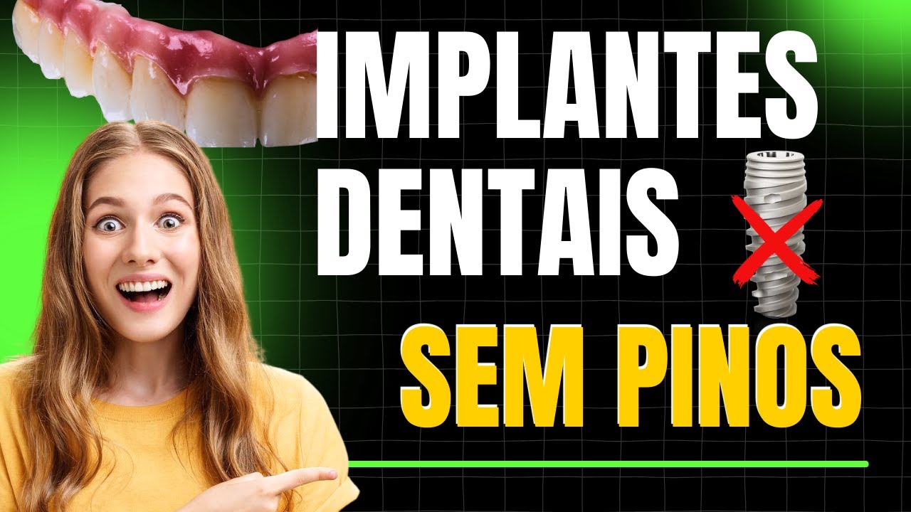 Implantes Dentais Sem Pinos! Custom Life: A Revolução da Prótese Protocolo