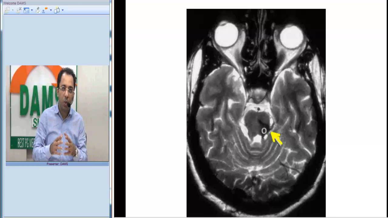 Radiology Spotter Series:32,  Hypertrophic-olivary-degeneration by Dr Sumer Sethi