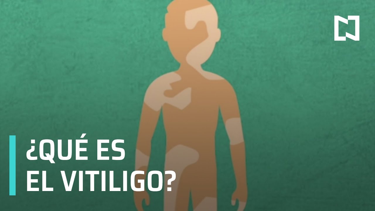 ¿Qué es el vitíligo? - Noticias MX