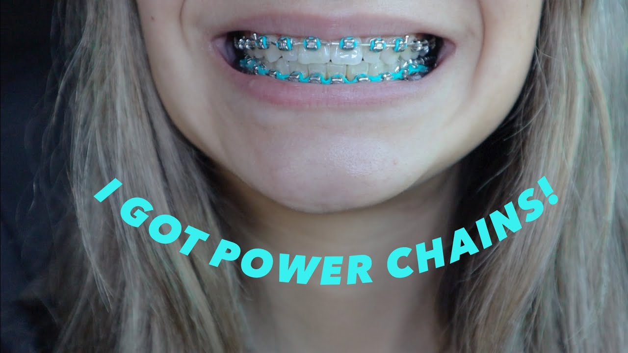 8 MONTH BRACES UPDATE// POWER CHAINS AND NO MORE RUBBER BANDS!