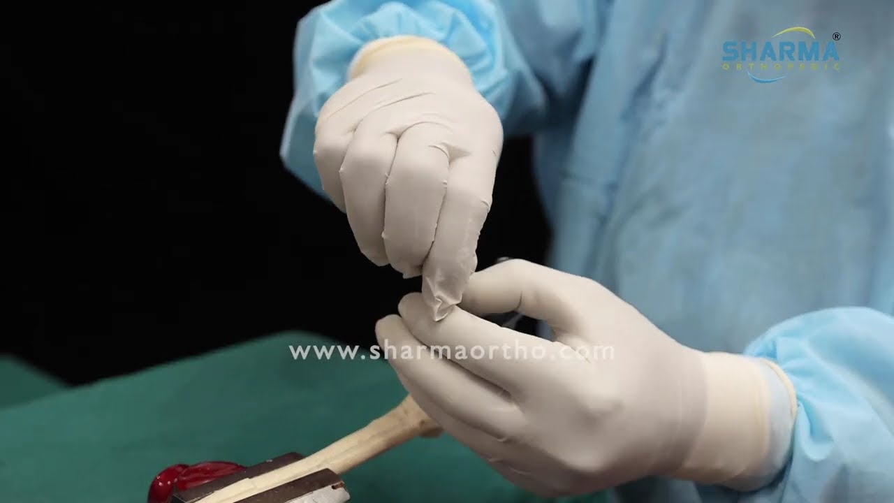 Radius Nail I Ulna Nail I Elegant