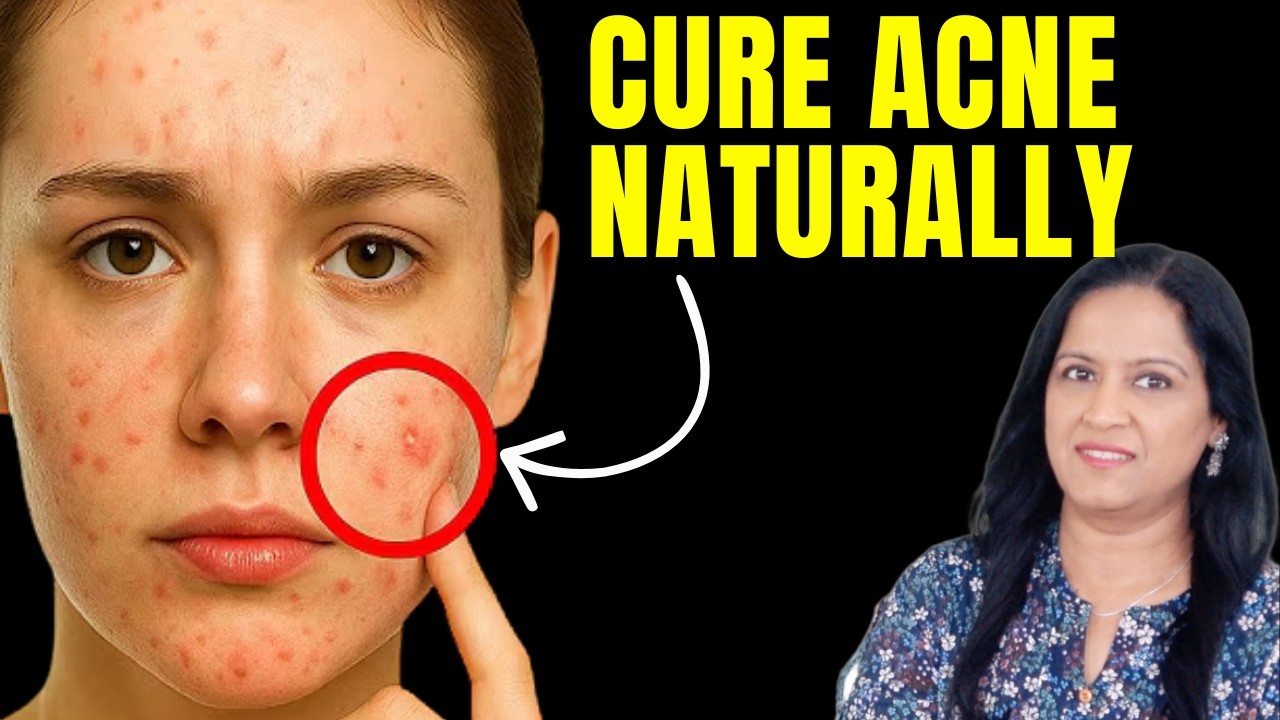 Как избавиться от прыщей и угревой сыпи естественными способами?