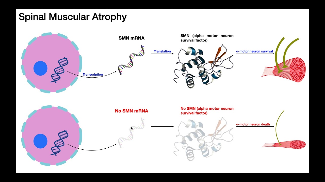 Spinal Muscular Atrophy | Mechanism & Presentation