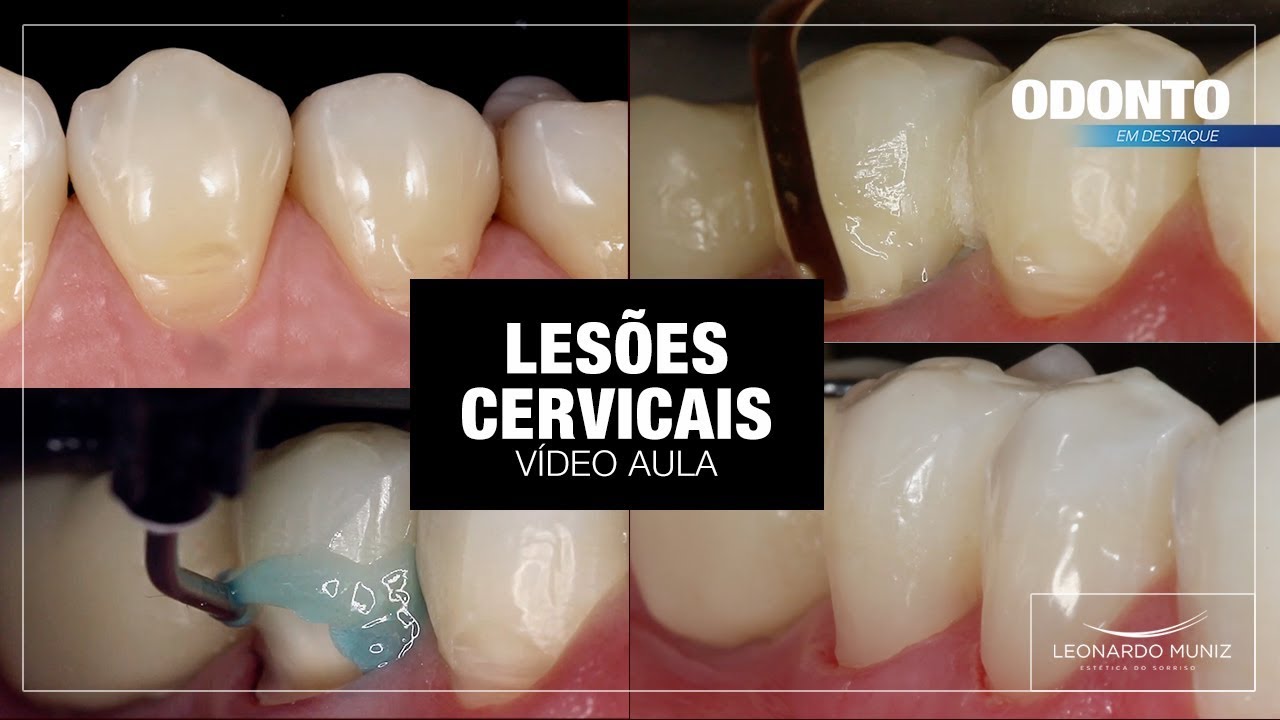 Video Aula: Restaurações Cervicais | Leonardo Muniz