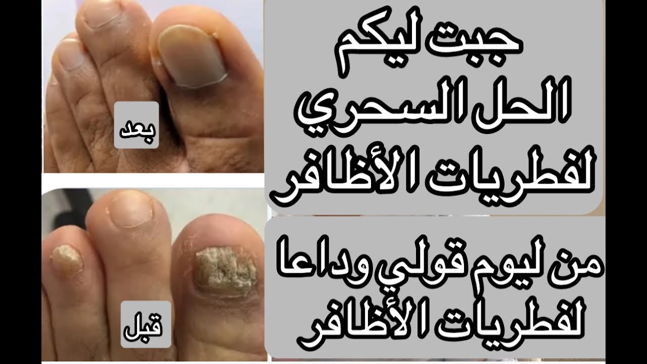 أحسن دواء لعلاج فطريات الأظافر تجربتي الشخصية مع فطريات الأظافر و كيفاش تهنيت منها