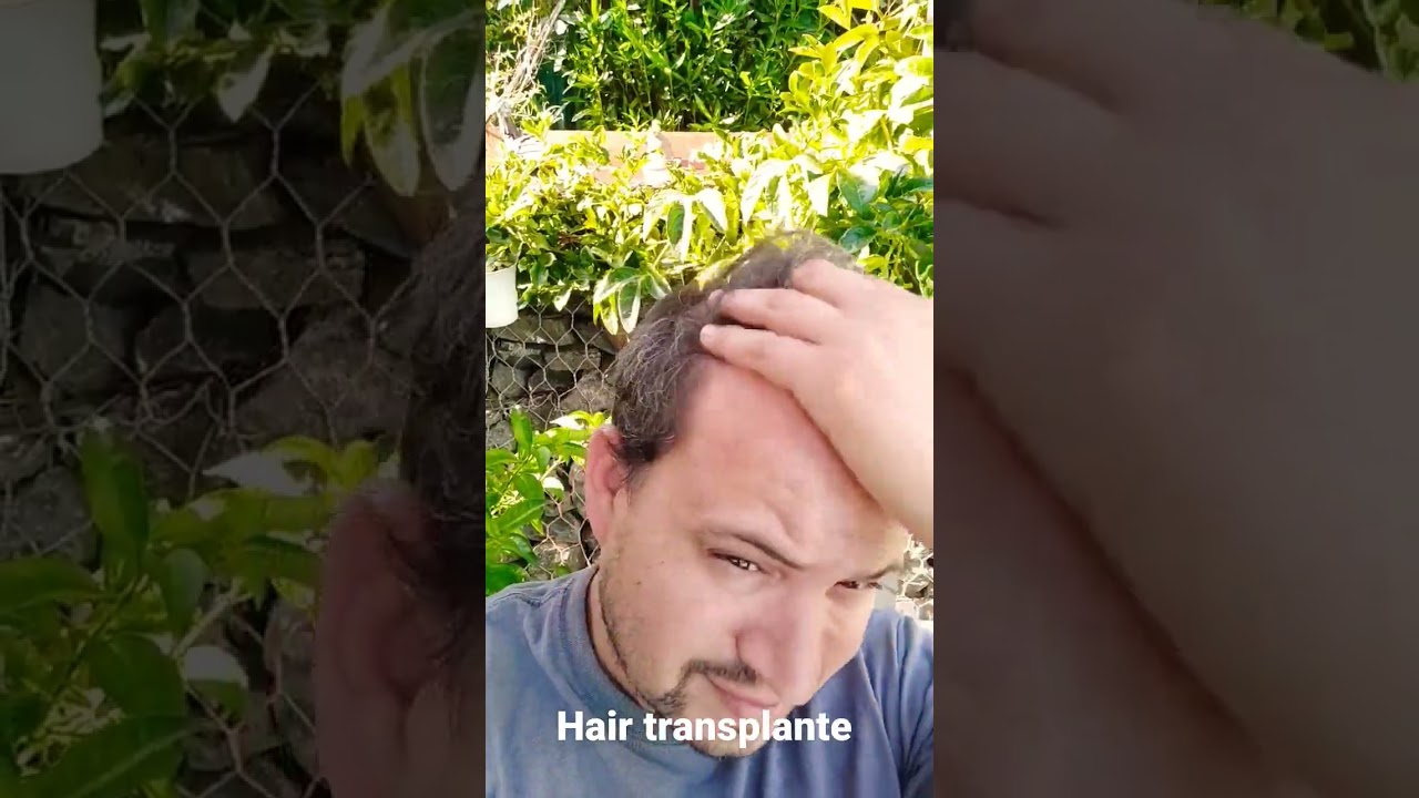 8 Meses Hair transplante in Istambul 