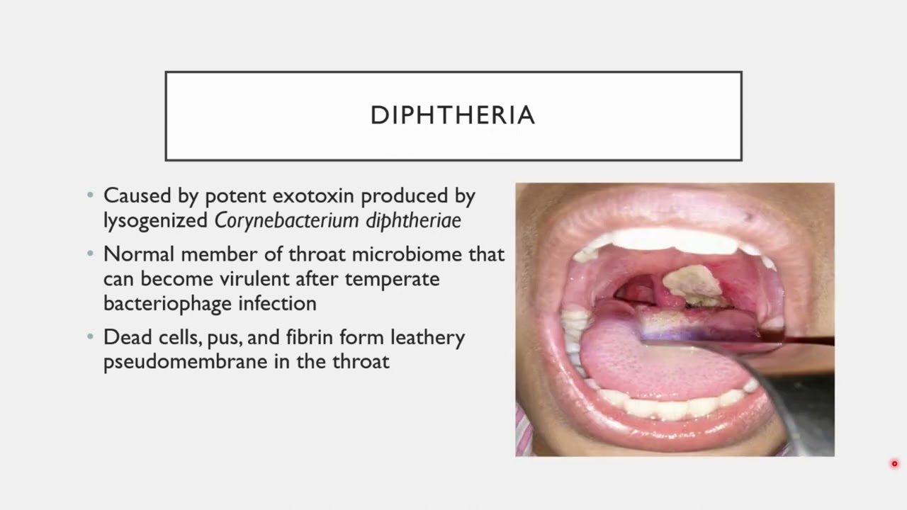 BIO 205 - Chapter 22 - Respiratory Infections