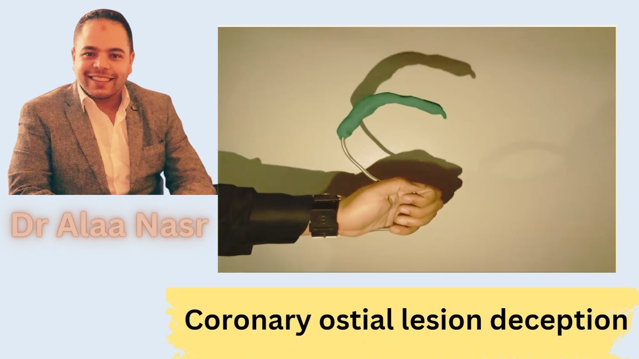 Ostial lesion deception in coronary angiography made easy, Dr Alaa Nasr, 2023