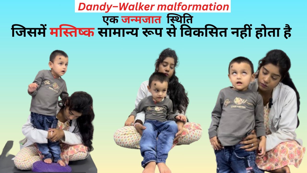 Dandy walker syndrome! Abnormal child  #phsiotherapy