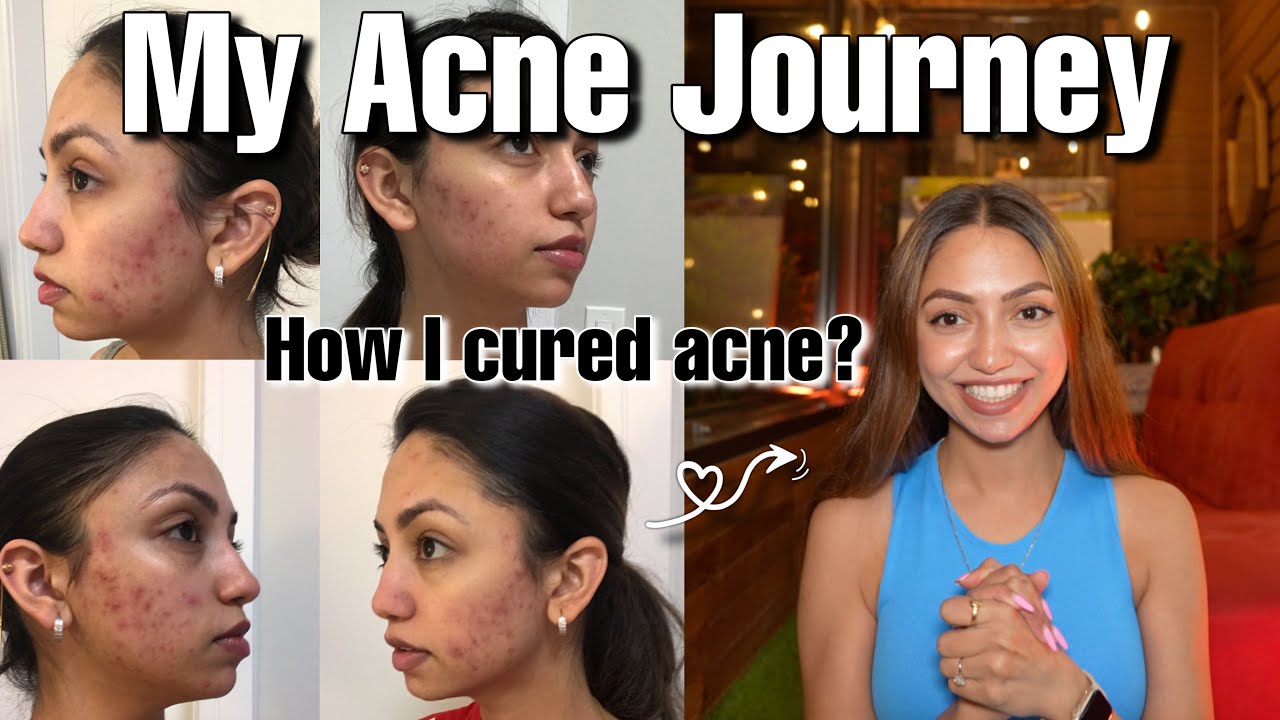 My Acne Journey in Canada | Skin Care Routine 2023
