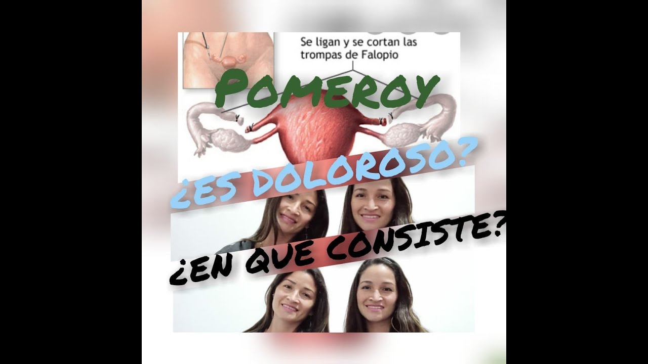 MI EXPERIENCIA CON EL POMEROY | Ligadura de trompas &iquest;Duele? &iquest;Es seguro? | Gemelas Doris y Rosa