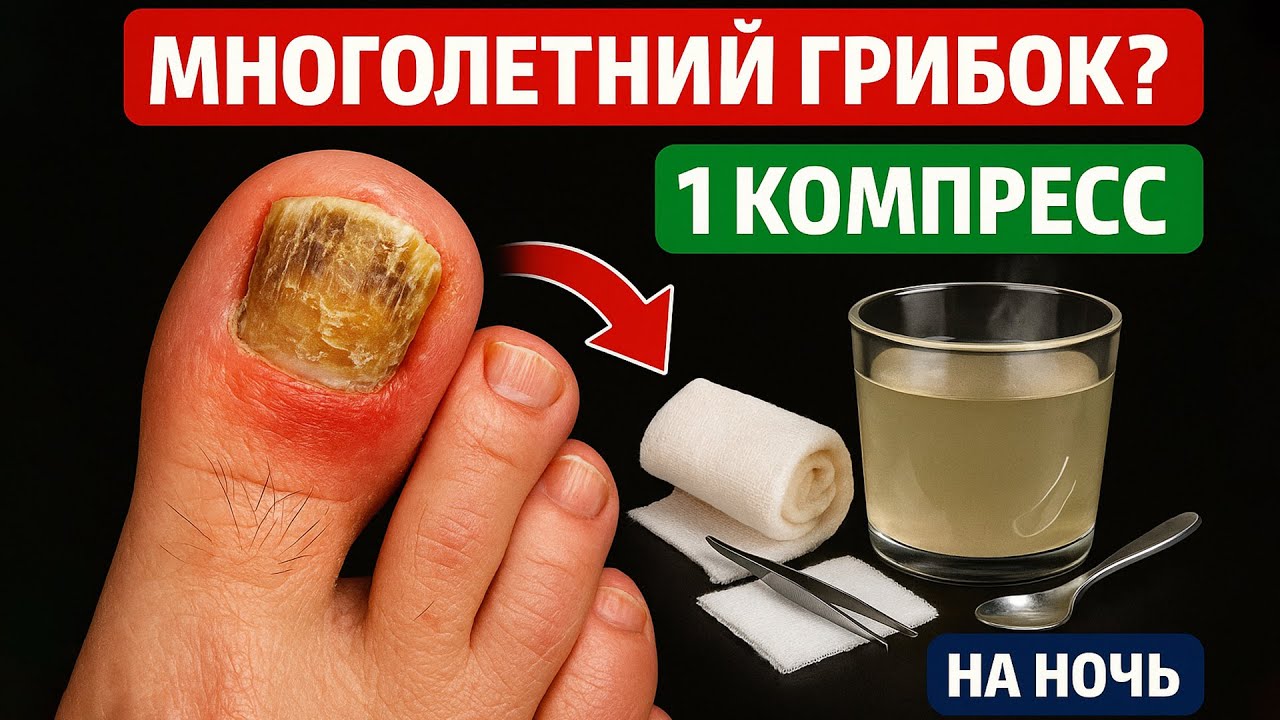 Грибок ногтей растворяется на глазах — проверенный способ