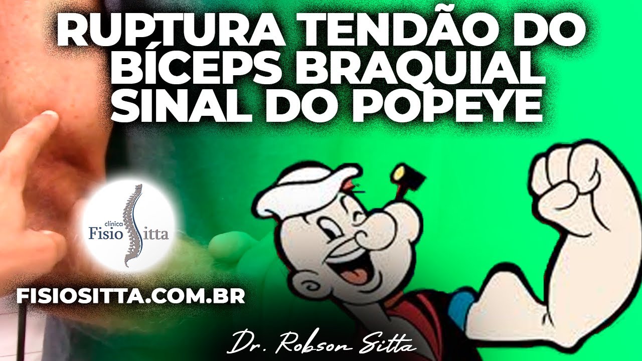 LESÃO RUPTURA TENDÃO CABO LONGO do BÍCEPS BRAQUIAL SINAL do POPEYE Fisioterapia Dr. Robson Sitta