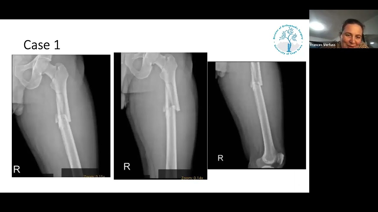 Kirsty Berry- Femur fractures
